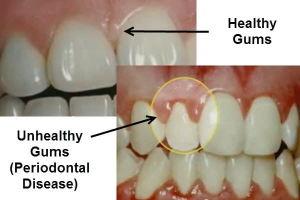 Read more about the article How Common is Gum Disease?