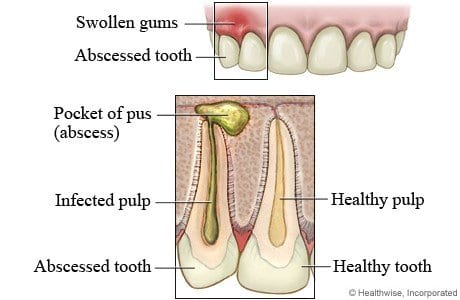 Read more about the article Abscessed Tooth Treatment Calgary NW