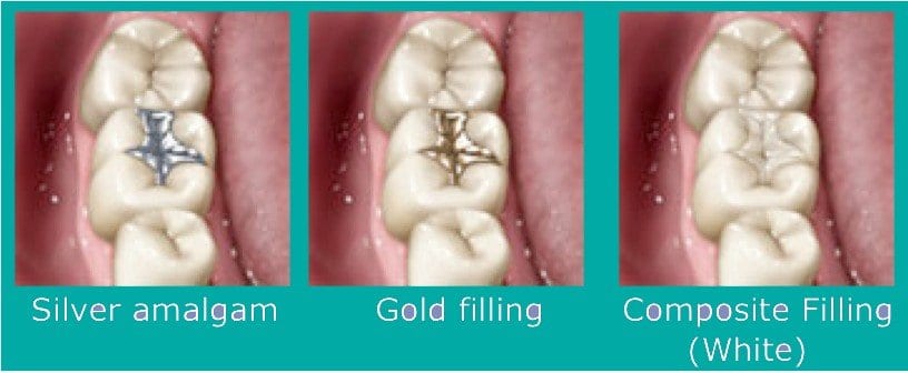 Read more about the article The only way to fill a cavity is by using ‘silver fillings.’