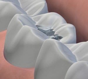 Read more about the article What Happens if I Lose a Tooth Filling?