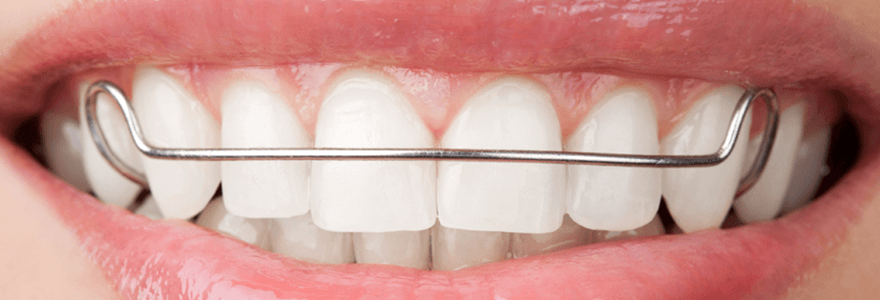 Read more about the article Caring for Teeth with Braces and Retainers