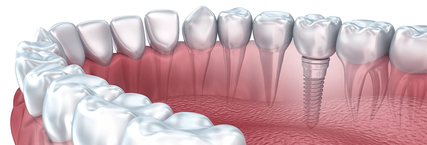 Read more about the article Why Get Dental Implants ?