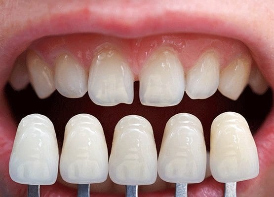 Read more about the article Alternatives to Dental Veneers