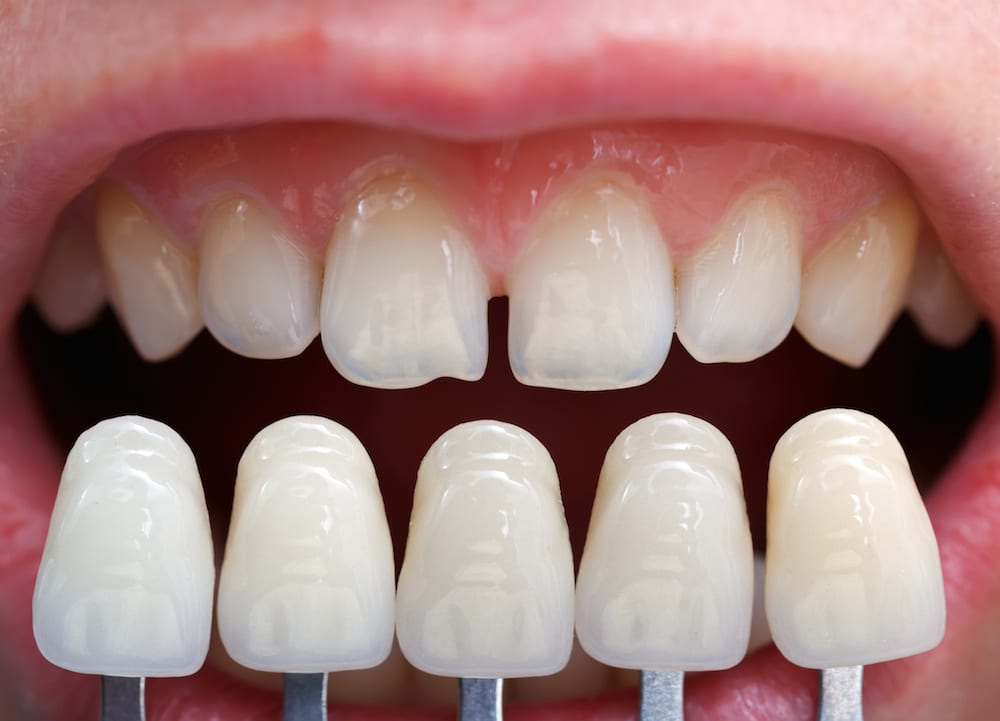 Read more about the article Life Span of Dental Veneers
