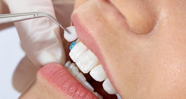 Read more about the article Procedure of Dental Veneers