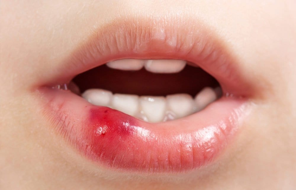 Read more about the article What Can I Do When Dental Tissue Is Injured?