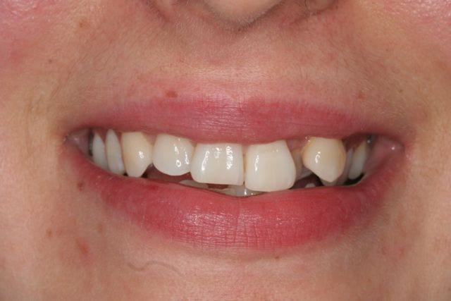 Read more about the article What to do if Tooth is pushed out of Position?