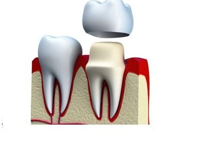 Read more about the article Types of Dental Crowns