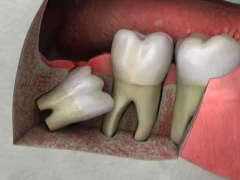 Read more about the article Some Facts About Wisdom Teeth