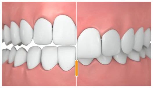 Read more about the article What is Underbite, Overbite and Crossbite?