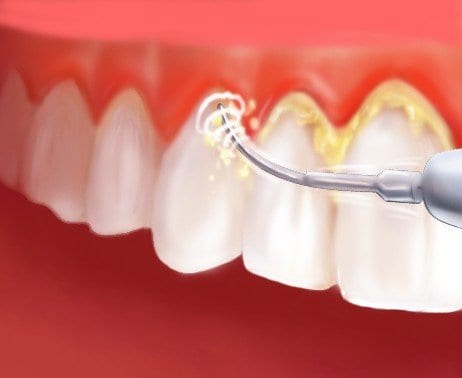 Read more about the article Is Deep Cleaning Good or Bad for Gum Disease?