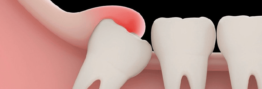 Read more about the article Impacted Wisdom Teeth and Its Warning Symptoms