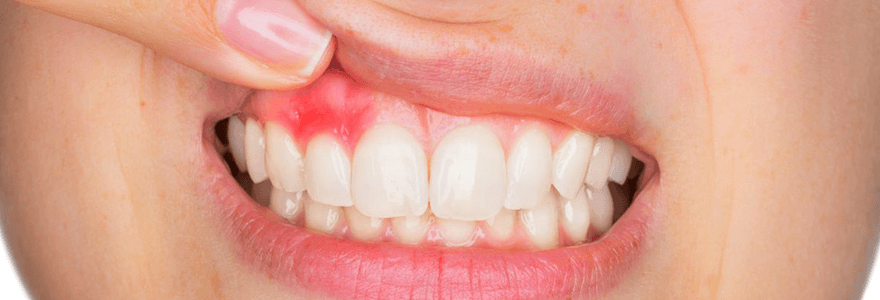 Read more about the article Three Symptoms That You May Have Gingivitis