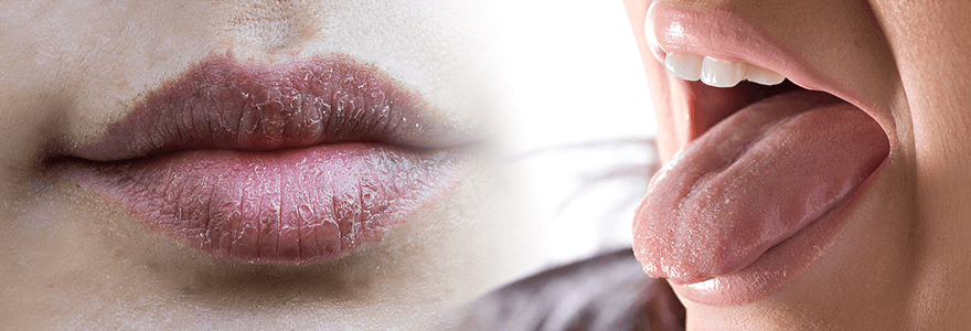 Read more about the article Dry Mouth Shouldn’t Be Ignored