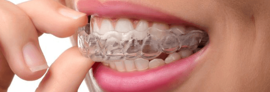 Read more about the article About Mouth Guards
