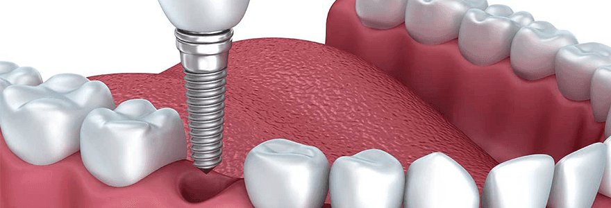 Read more about the article Why Should You Get Dental Implants?