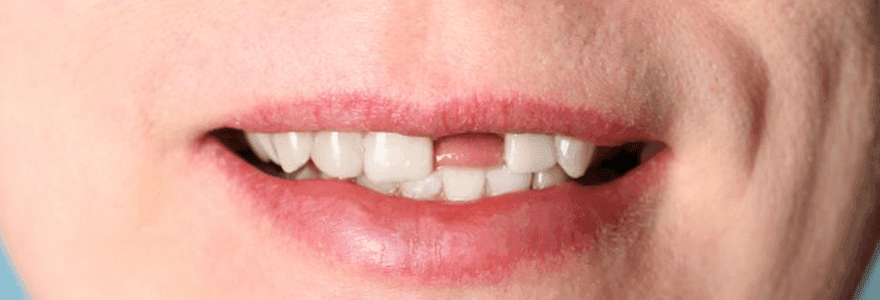 Read more about the article Dental Myth: Missing Teeth Are Always Replaced By Bridges Or Removable Dentures