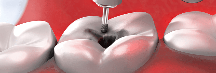 Read more about the article The Rising Tooth Decay Rates Amongst Young Canadians