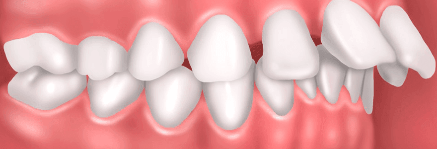 Read more about the article Reasons You Have Misaligned Teeth