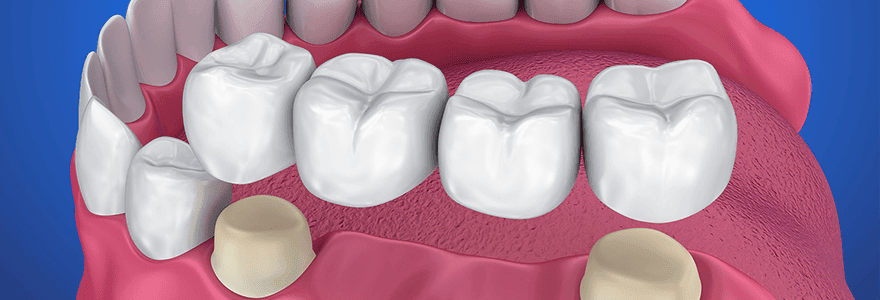 Read more about the article Replace Your Missing Tooth With Dental Crowns And Bridges