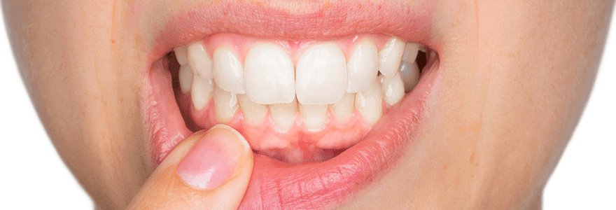 Soothe-Sore-Gums