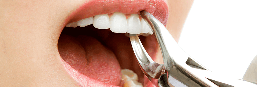 You are currently viewing Top 3 Reasons For Teeth Extraction