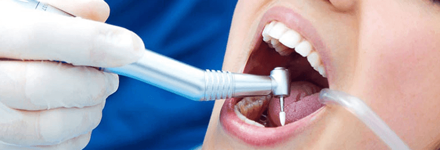 Same Day Emergency Dental Care Calgary NW 8 Visiting-a-Dentist-If-You-Have-a-Broken-Tooth