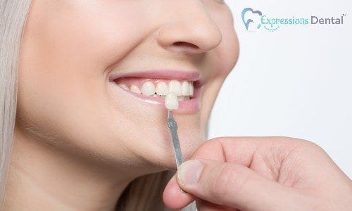 Read more about the article Ways Porcelain Veneers Can Enhance Your Smile