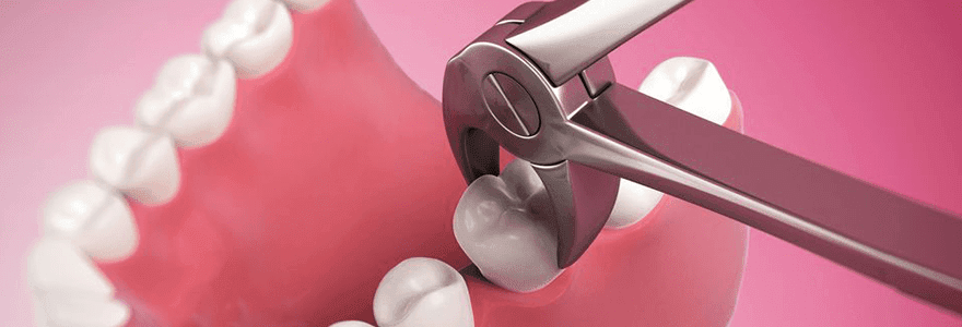 When-It-Is-Necessary-To-Extract-A-Tooth