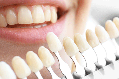 Composite-white-Filling1