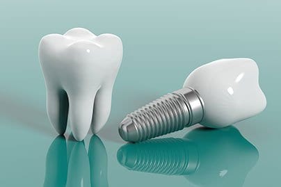 dental-implant-thumbnail