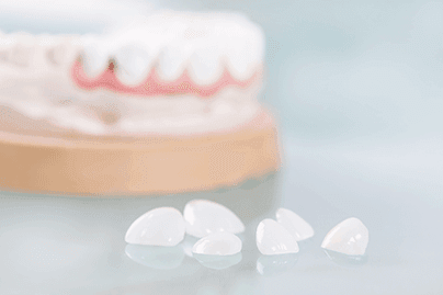 dental-veener-thumbnail