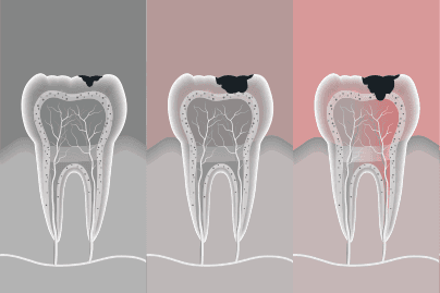 root-canel-thumbnail-image