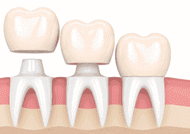 dental-bridge-thumbnail-image-270x191-min