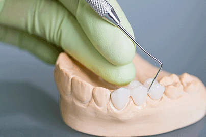 dental-bridge-thumbnail-image-2