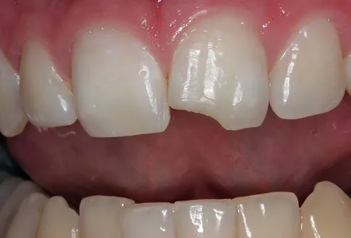 You are currently viewing Fractured Tooth