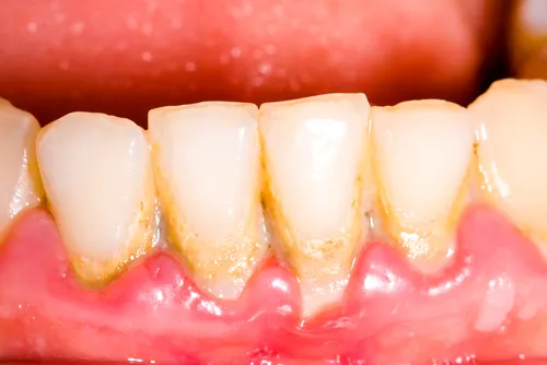 You are currently viewing Tips to Prevent Tartar Buildup