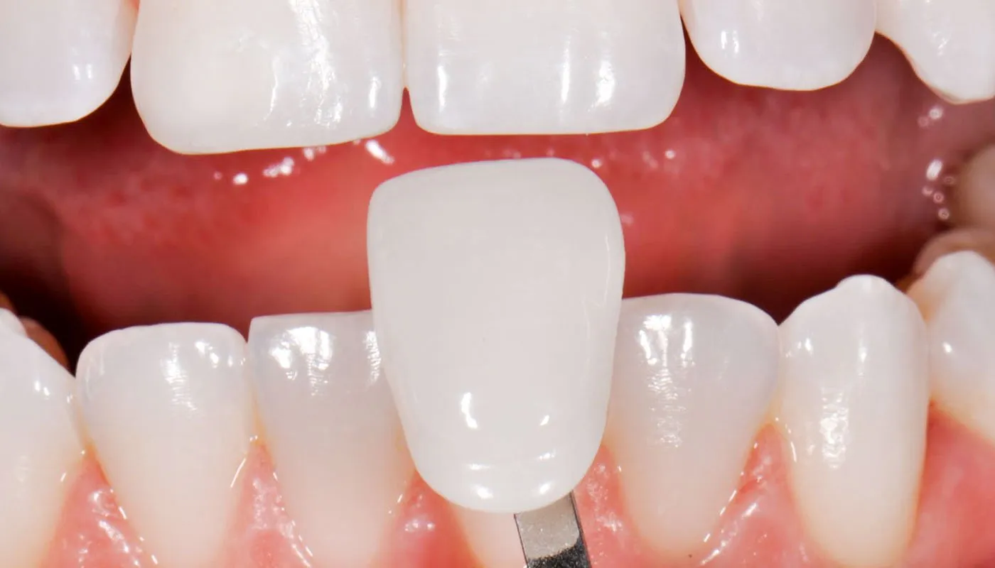 You are currently viewing Tips To Take Care of Dental Veneers?
