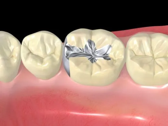 You are currently viewing Facts About Dental Sealants