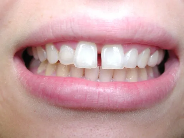 You are currently viewing How to Fix Gap between Front Teeth?
