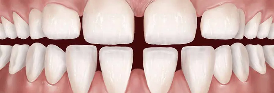 You are currently viewing Gaps Between Teeth: Causes and Solutions