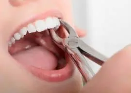 Dental Services 4 Tooth-Extraction-Featured-270x191
