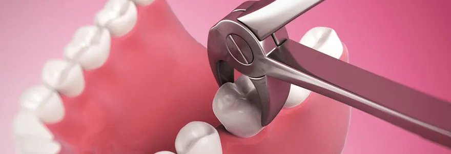 You are currently viewing When It Is Necessary To Extract A Tooth?