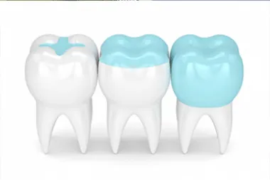Dental Services 13 filling-inlay-and-onlay-thumbnail-image-e1552741980602