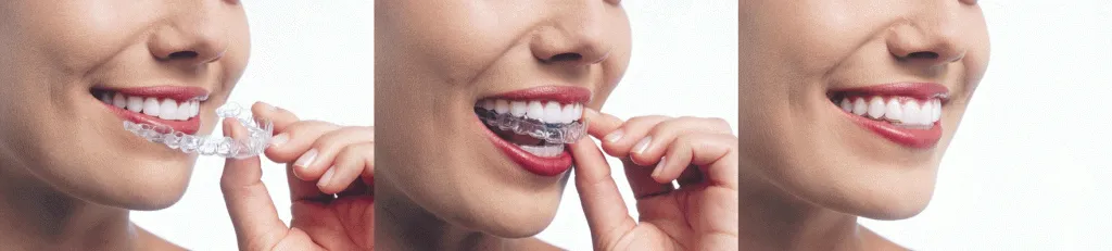 Invisalign Calgary NW 7 invisalign-content