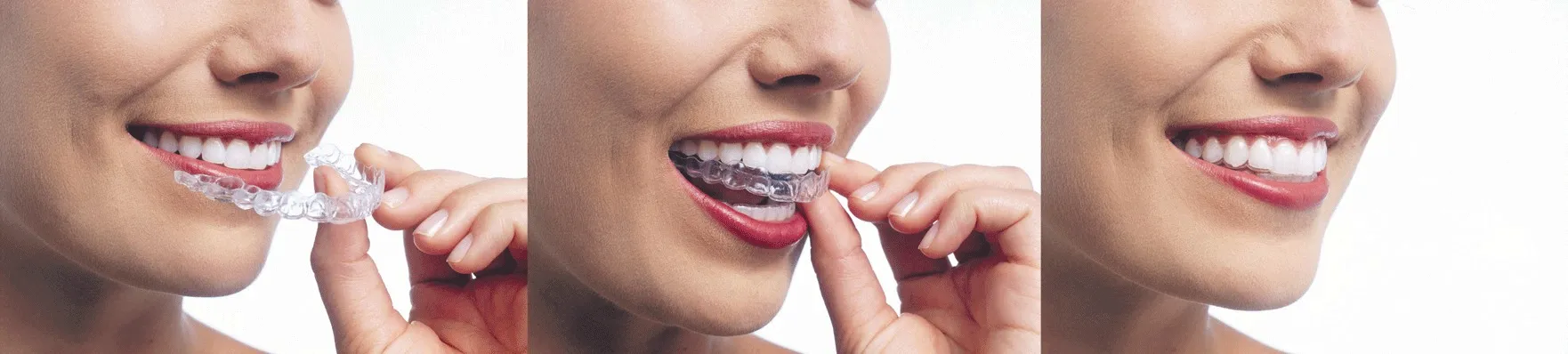 You are currently viewing How Do I Get Started with Invisalign?