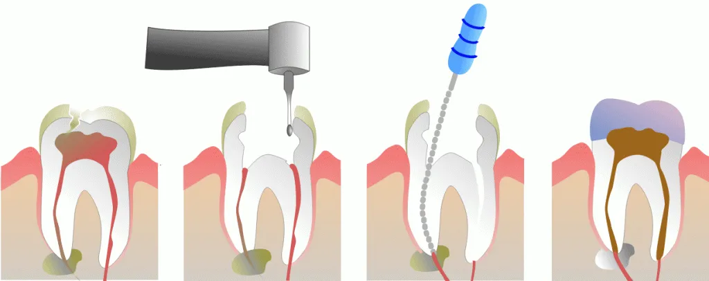 Root Canal Treatment Calgary 7 root-canal-procedure-image