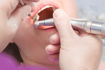 Dental Services 28 teeth-clening-thumbnail-image
