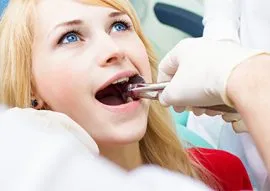 Dental Services 2 Wisdom-Teeth-Removal-Calgary-1