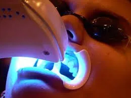 Zoom Teeth Whitening Calgary NW 7 zoom
